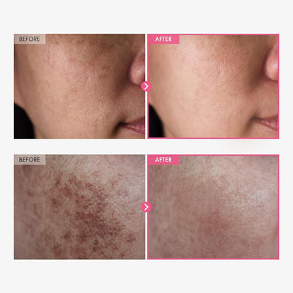 TOSOWOONG Arbutin 7% + Tranexamic Acid 4% Cream|  Visible Glow in Weeks